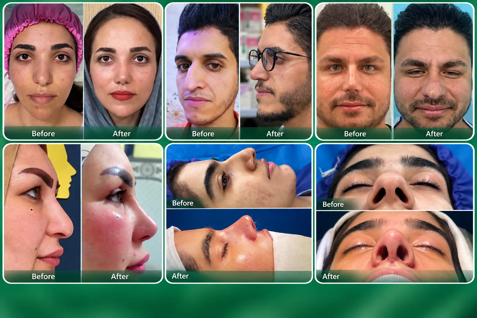 صور توضيحية لعمليات تجميل الأنف